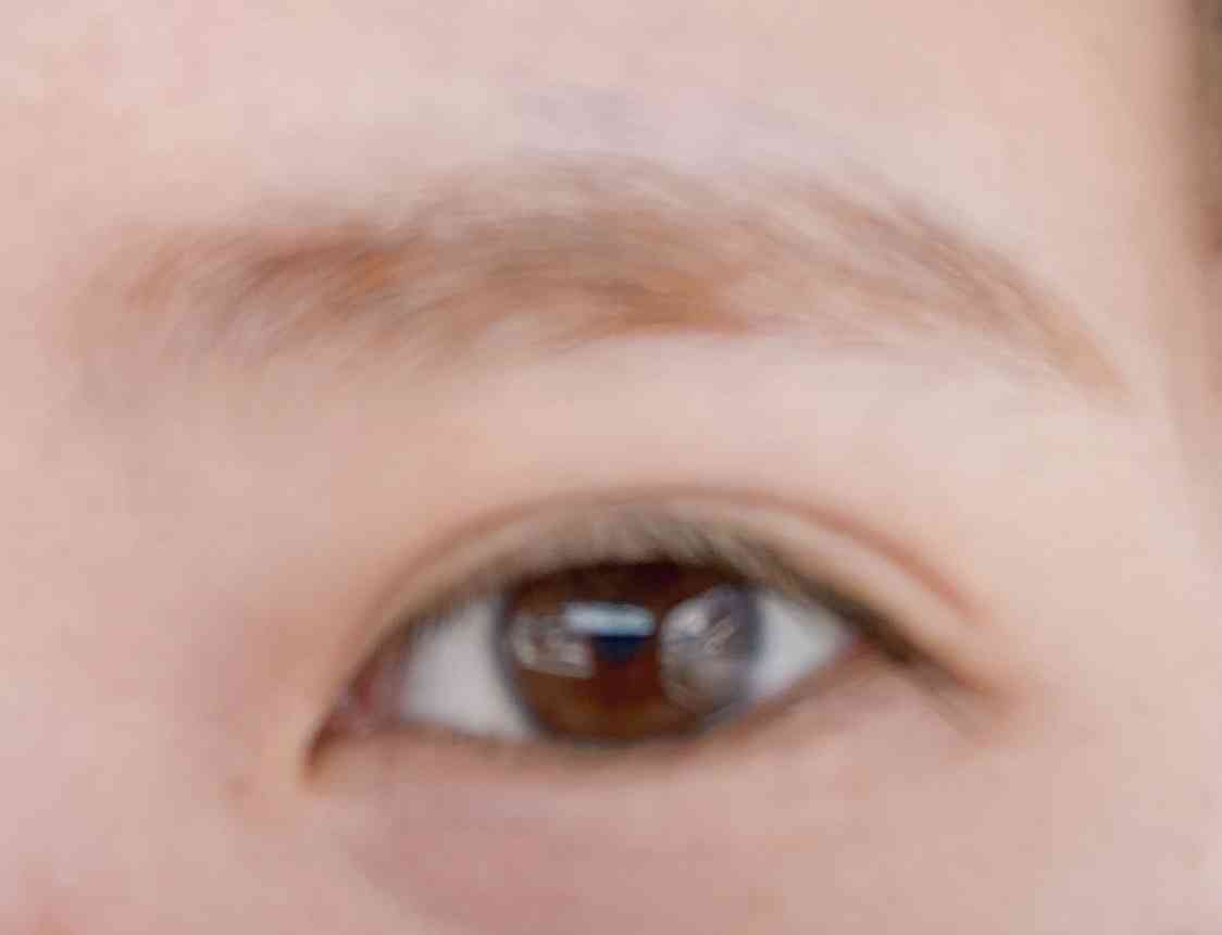 【二重整形】埋没取れやすい瞼の人、切開考えてますか?