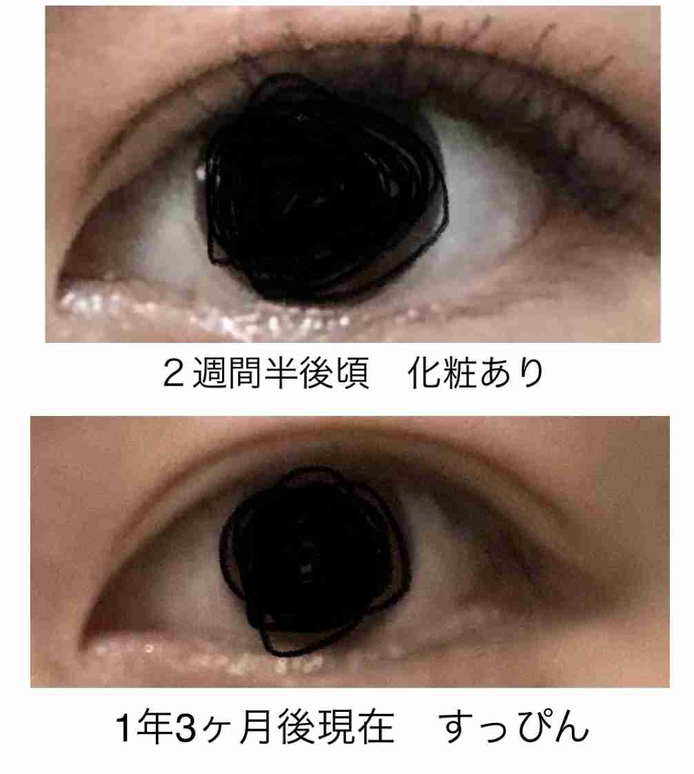 【二重整形】埋没取れやすい瞼の人、切開考えてますか?