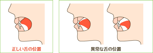 大人になってからの歯列矯正