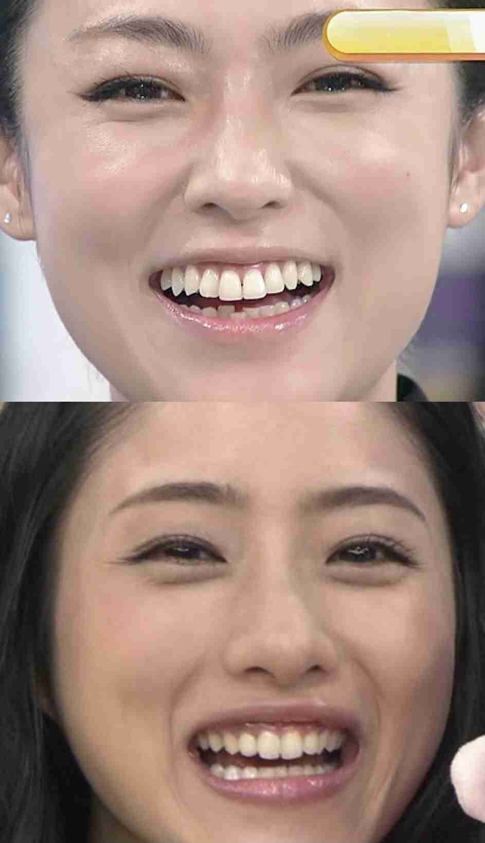 大人になってからの歯列矯正