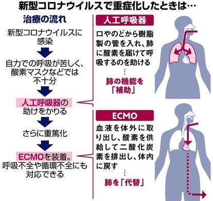 基礎疾患なし重症20代女性に人工肺装着 若い世代の重症化深刻に