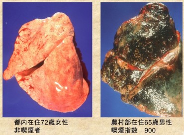 母親にタバコをやめてほしい