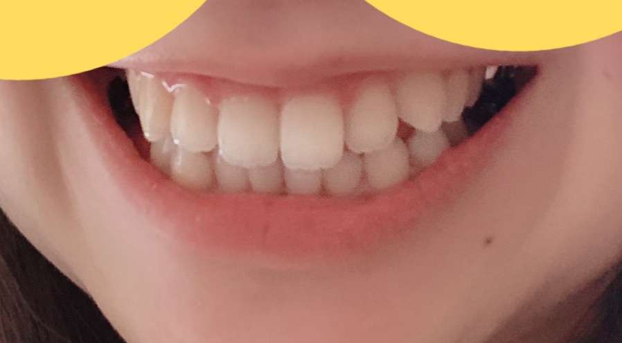マウスピース矯正をしてる方 考え中の方