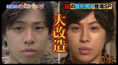 お直し総額は1億円超え！ 元祖整形男子・アレンが語る「大失敗した施術」と顔面の惨劇 | ガールズちゃんねる - Girls Channel