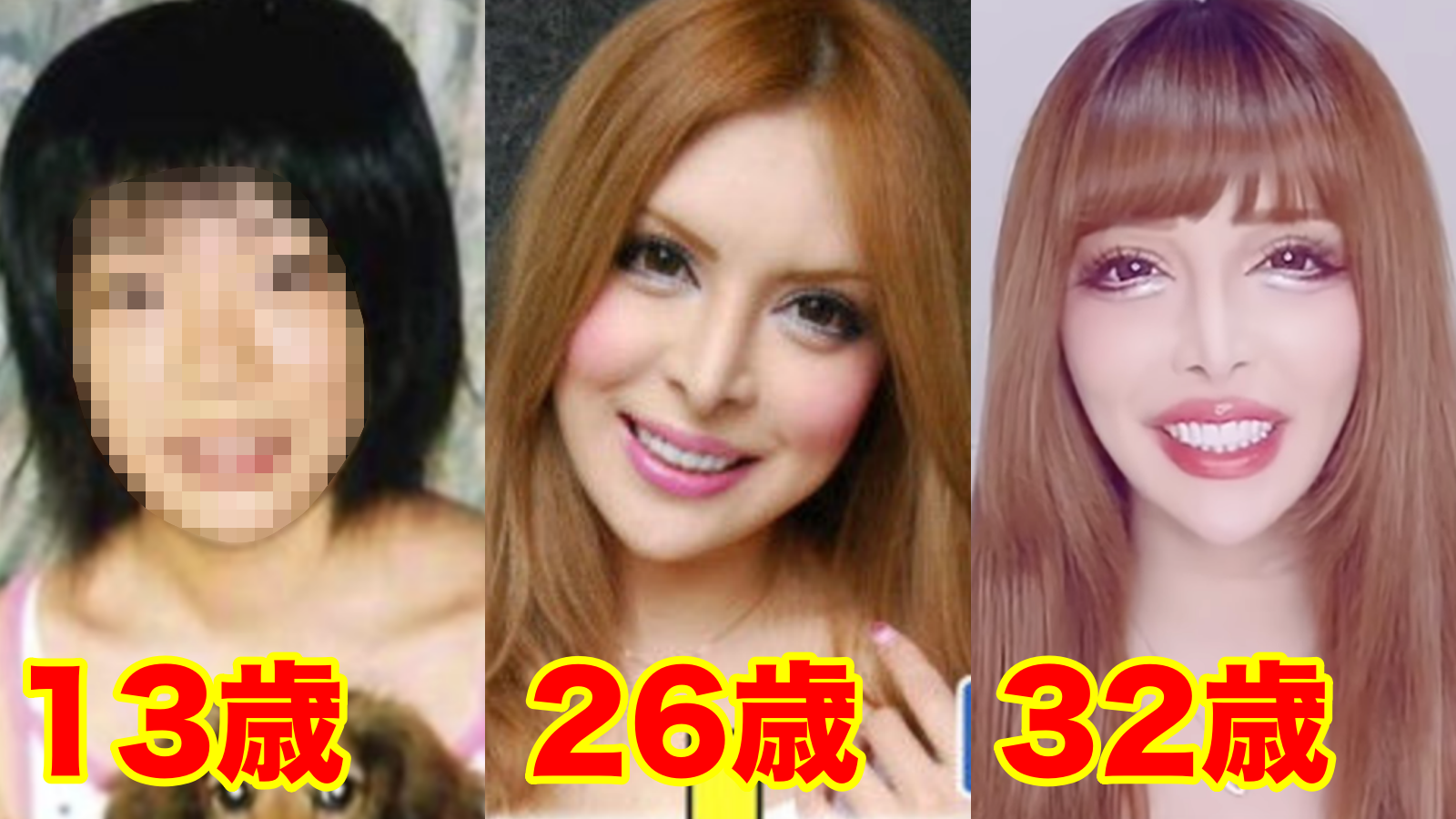 お直し総額は1億円超え! 元祖整形男子・アレンが語る「大失敗した施術」と顔面の惨劇
