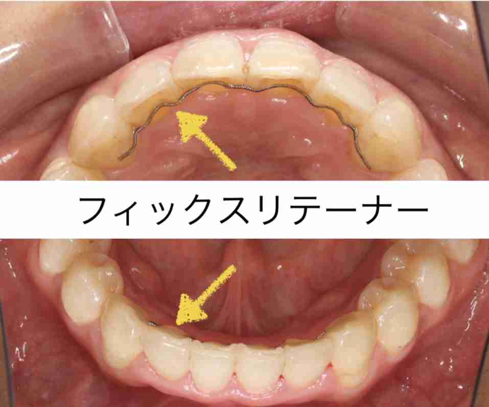 インビザライン矯正やってる人!【Part3】