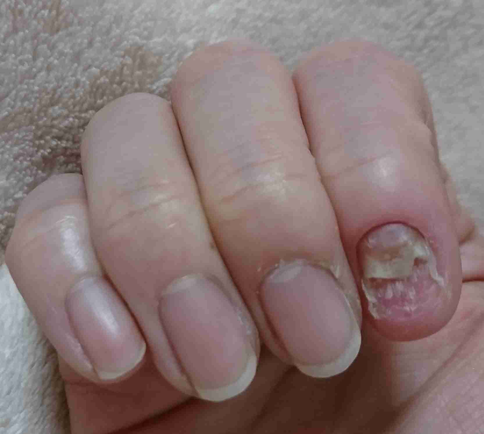 爪甲剥離 そうこうはくり したことある人 ガールズちゃんねる Girls Channel