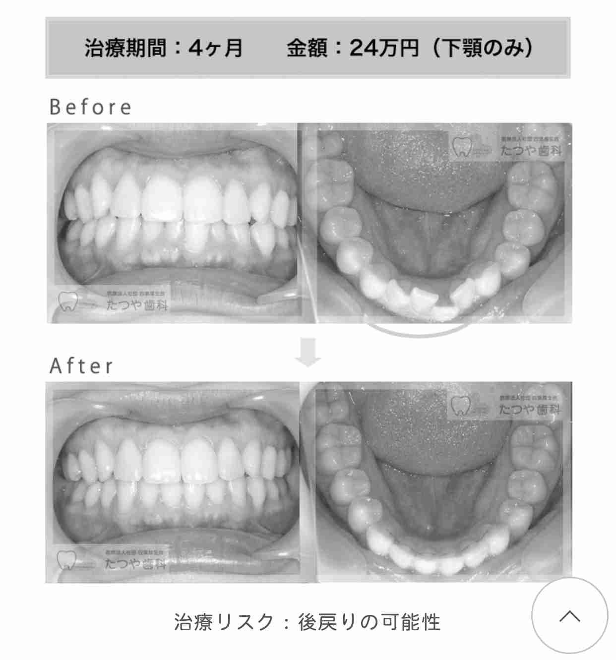 大人になってから歯列矯正をした方