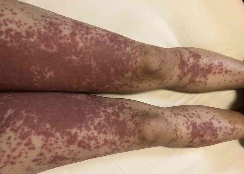 【コロナ】ワクチン3回目、打ちますか？