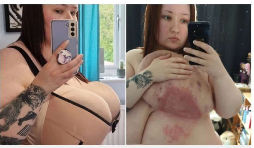 Pカップの胸に悩まされていた女性、寄付を募り縮小手術を受ける（英）