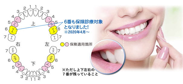 銀歯ある人