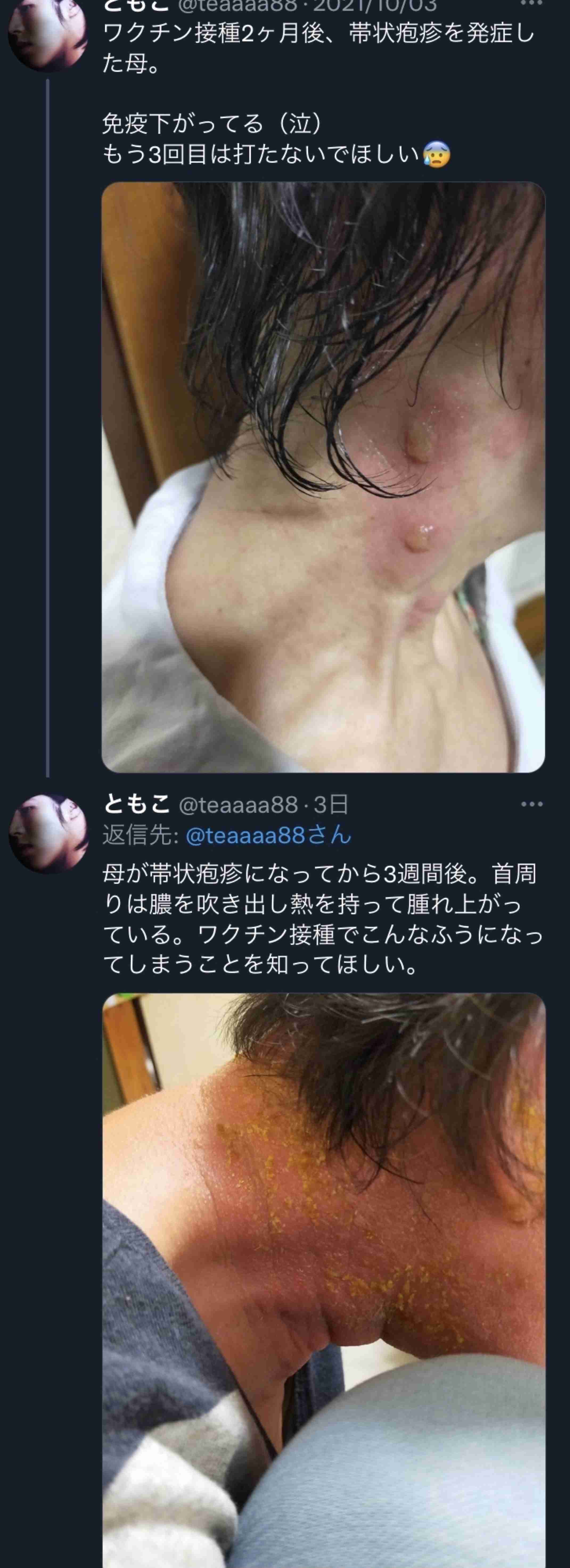 King & Prince・平野紫耀が心身の限界で帯状疱疹、「ポスト嵐」を背負うエースの現実