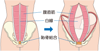 妊娠線がガッツリ残った人