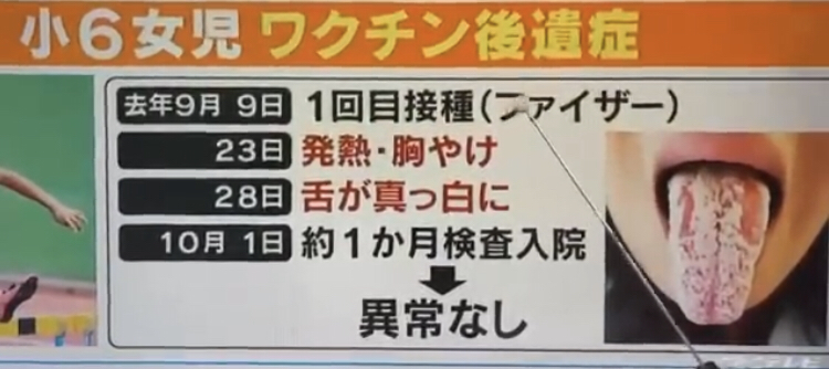接種後に「熱出た人ほどワクチン効果高い」　九大病院など発表
