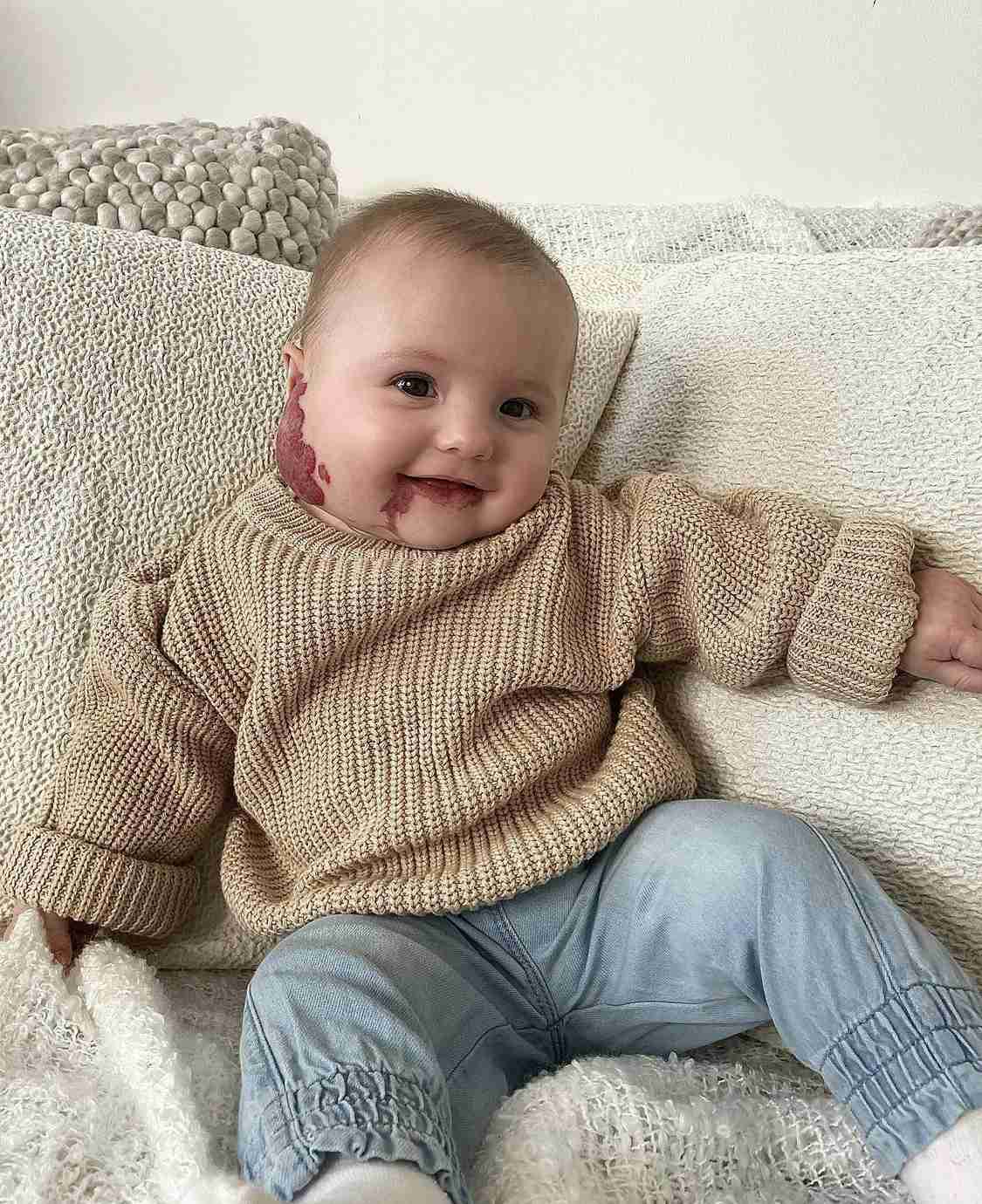 生まれつき顔に赤いあざのある赤ちゃん　「虐待を疑われたことも」と母親（英）