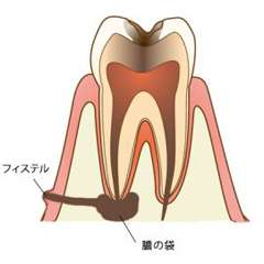 歯根膜炎になったことがある方