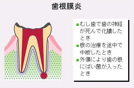 歯根膜炎になったことがある方
