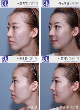 歯の矯正をして後悔してる人