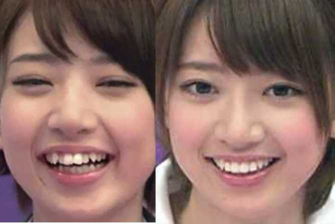 歯の矯正をして後悔してる人