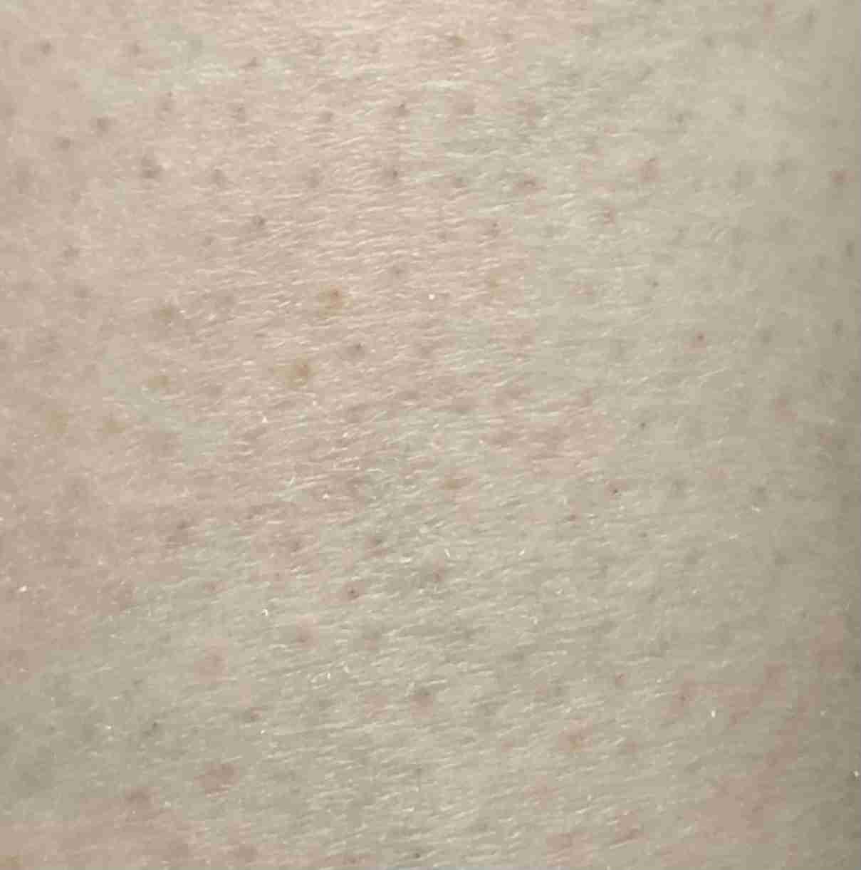 脚の毛穴を目立たなくしたい