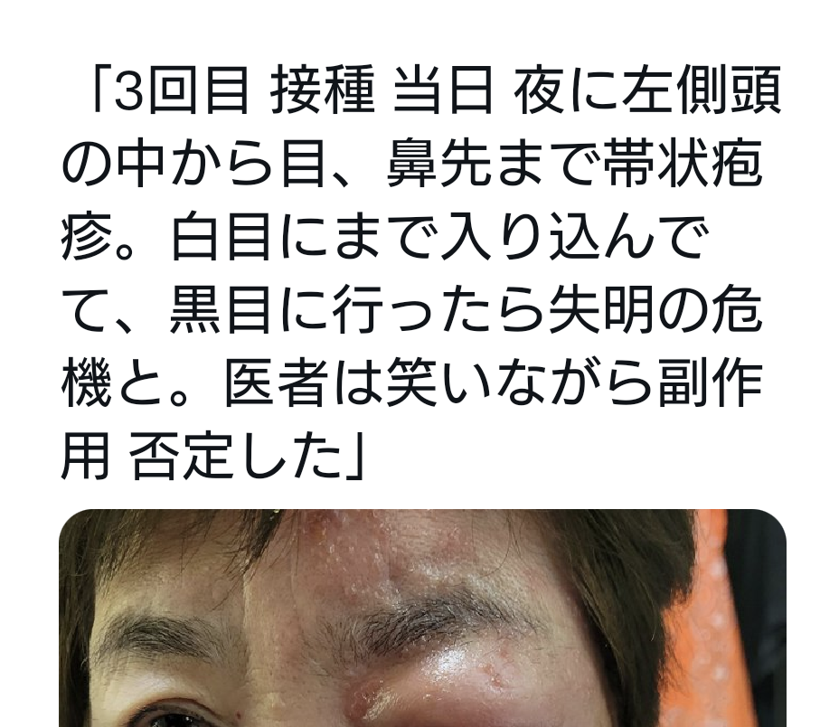「帯状ほう疹」患者が急増 3回目接種後に発症した男性(20代)の場合は…