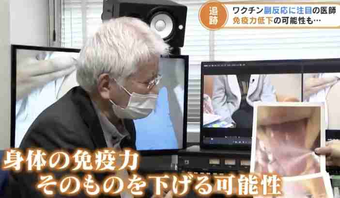 「帯状ほう疹」患者が急増 3回目接種後に発症した男性(20代)の場合は…