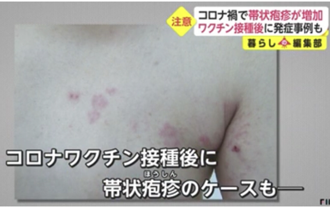 「帯状ほう疹」患者が急増 3回目接種後に発症した男性(20代)の場合は…