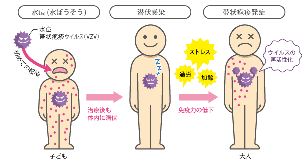 「帯状ほう疹」患者が急増 3回目接種後に発症した男性(20代)の場合は…