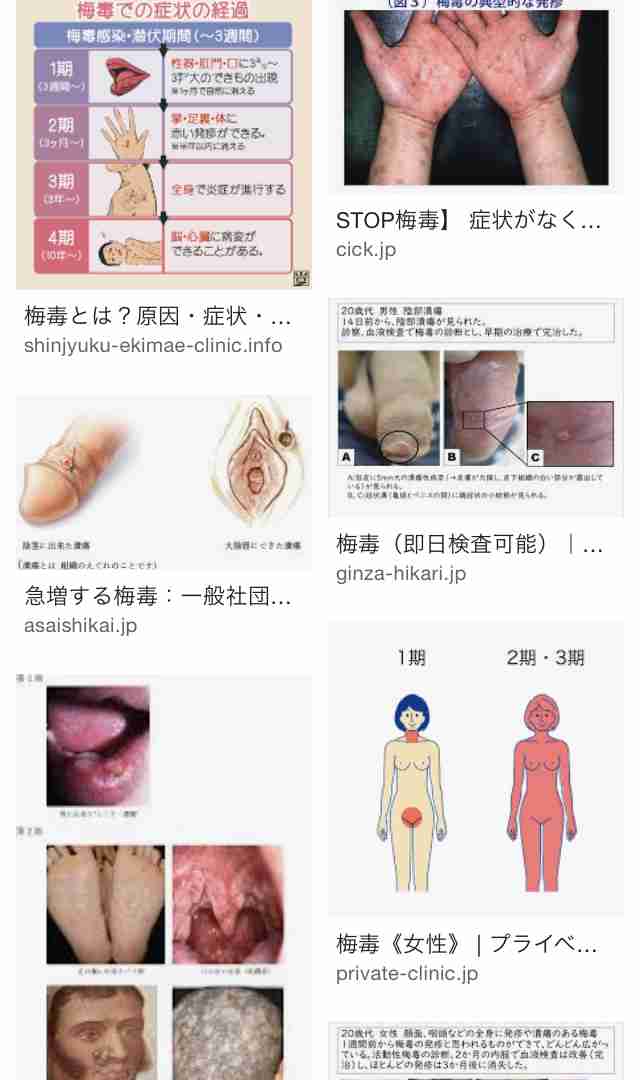 梅毒患者が急増　過去最多の21年同期比1.6倍　10年続く流行