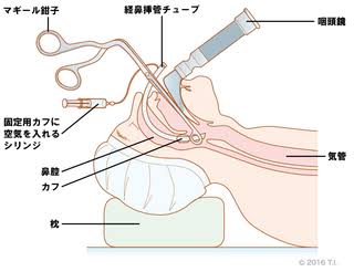 全身麻酔の初体験