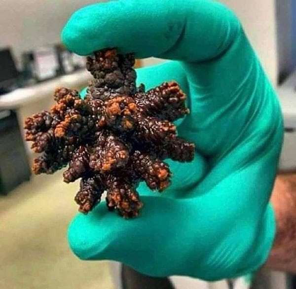 尿管結石経験者の方