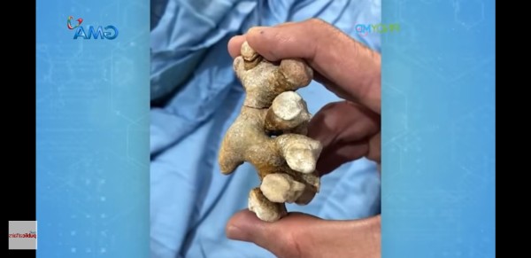 尿管結石経験者の方