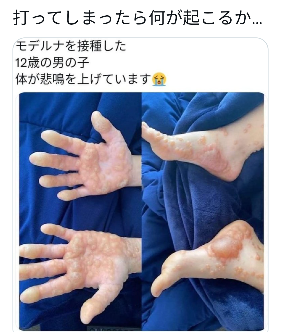 新型コロナワクチン打っても“未接種扱い”にしていた…厚労省「理由は不明だが意図的なものではない」
