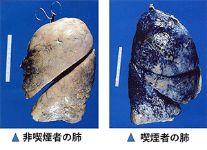 タバコを辞めない夫。どうしたらやめてくれる?