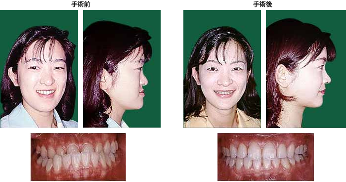 顎のインプラント手術