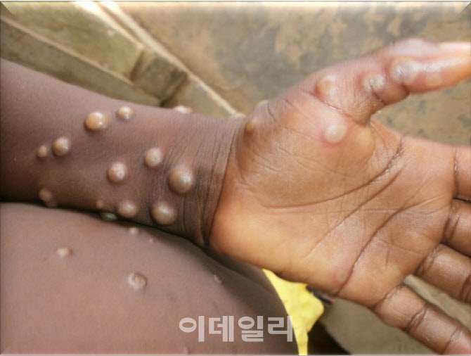 サル痘、欧州の危険性「高い」に 50カ国に感染拡大