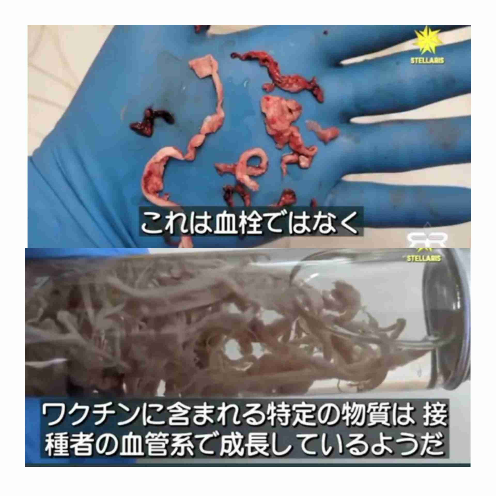 サル痘、欧州の危険性「高い」に 50カ国に感染拡大