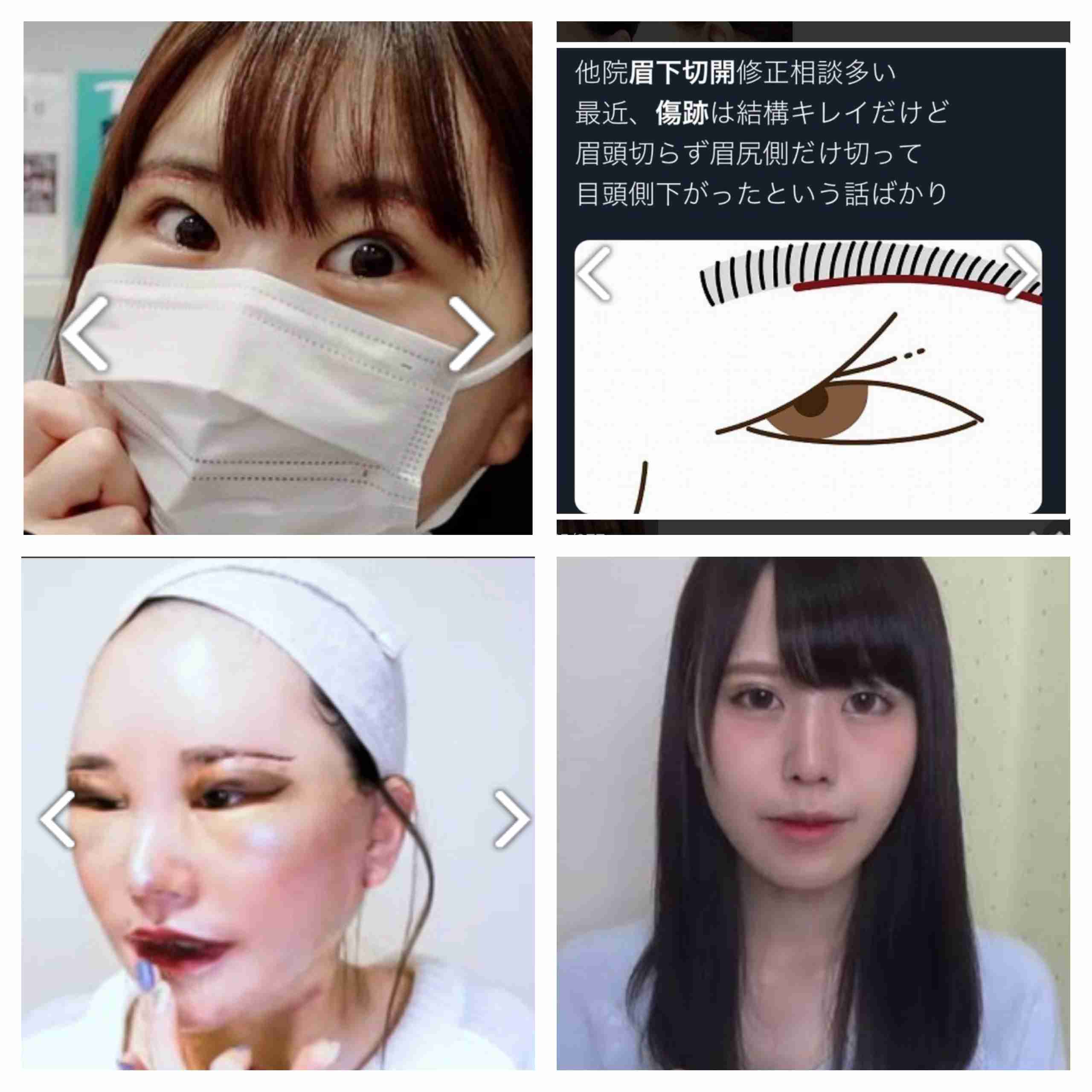 【閲覧注意】総費用1千万超「整形アイドル」轟ちゃん、壮絶な「ダウンタイム」報告 目周り黄色く腫れ...「痛すぎて嘔吐した」
