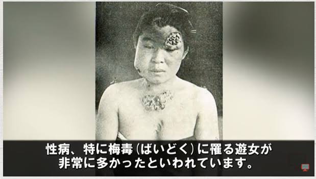 性感染症　80代の患者も…思い当たる出来事があればすぐ検査を