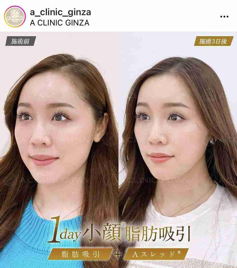 元キャバ嬢社長でモデルの愛沢えみり、33歳最新ショット＆整形総額費用を告白「目、鼻、歯…」