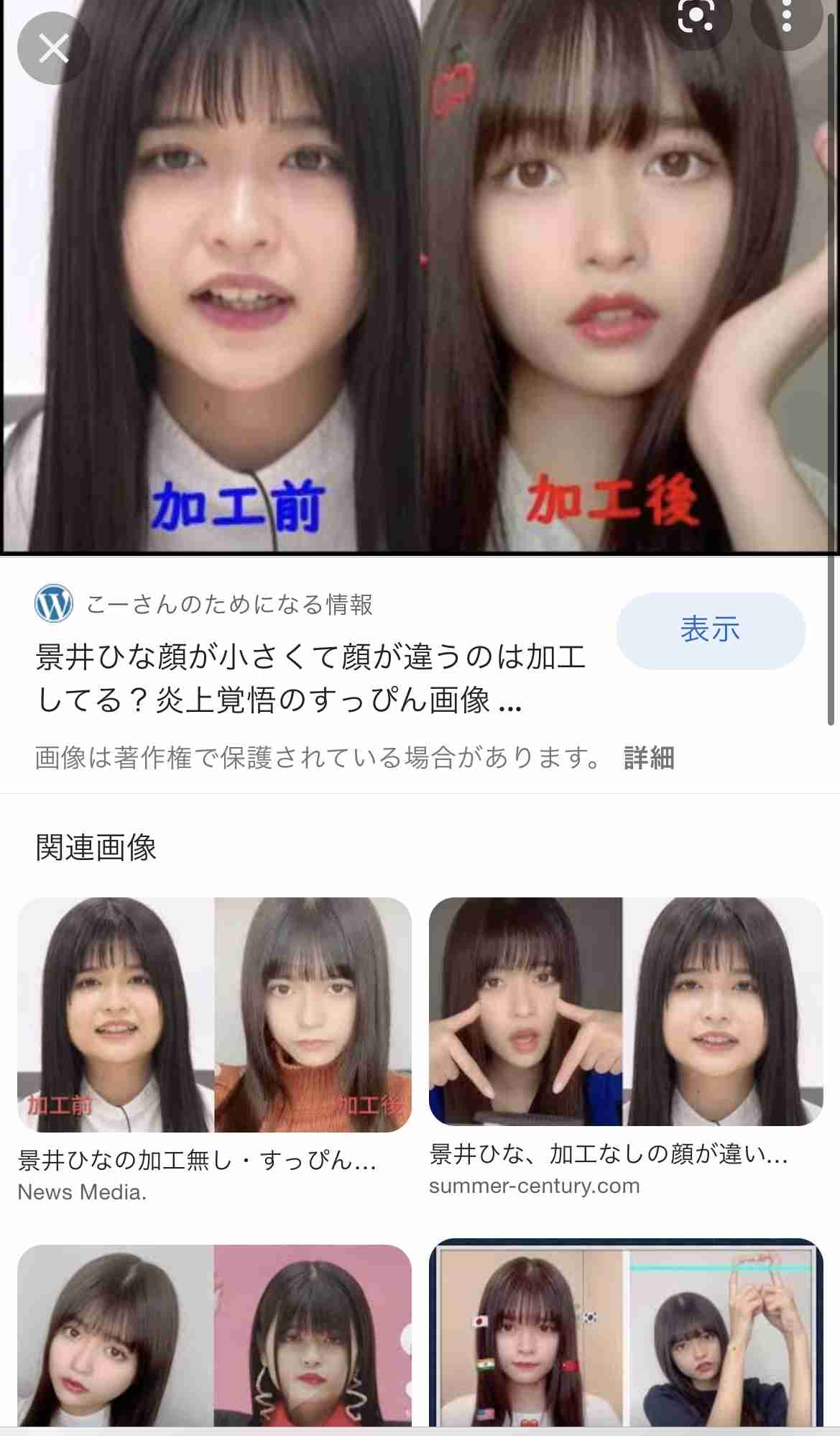 “離れ目の童顔になりたい”眼球の位置を変えようとした女性 “フル整形4周目”突入も「もうこれ以上はできないのがつらい」