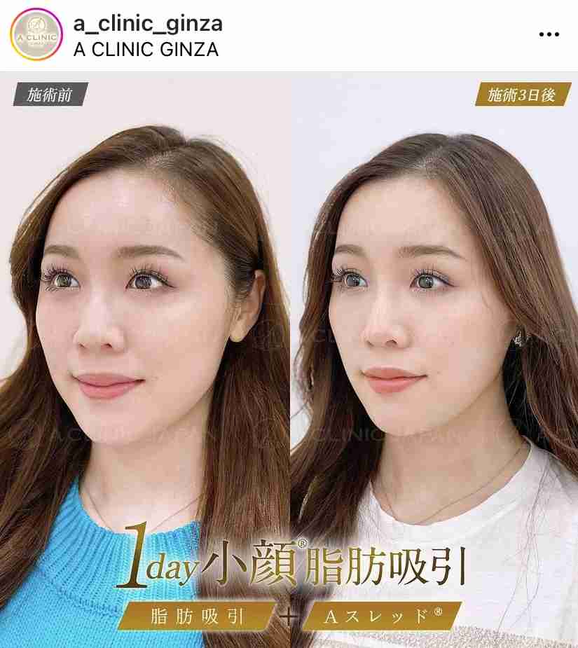 “離れ目の童顔になりたい”眼球の位置を変えようとした女性 “フル整形4周目”突入も「もうこれ以上はできないのがつらい」
