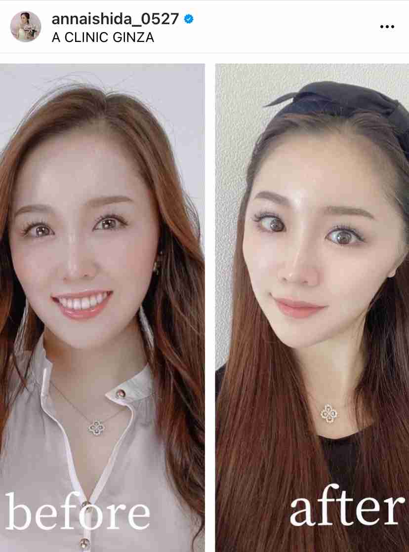 “離れ目の童顔になりたい”眼球の位置を変えようとした女性 “フル整形4周目”突入も「もうこれ以上はできないのがつらい」