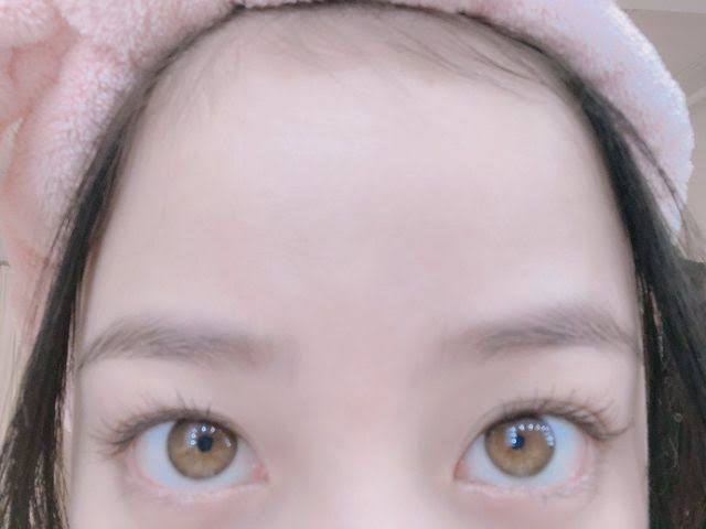“離れ目の童顔になりたい”眼球の位置を変えようとした女性 “フル整形4周目”突入も「もうこれ以上はできないのがつらい」