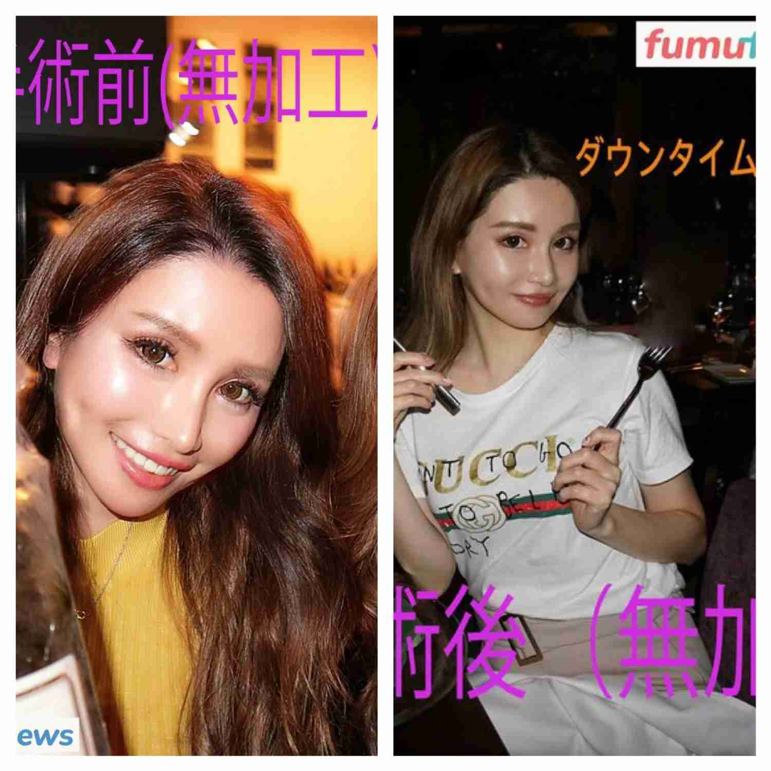 “離れ目の童顔になりたい”眼球の位置を変えようとした女性 “フル整形4周目”突入も「もうこれ以上はできないのがつらい」