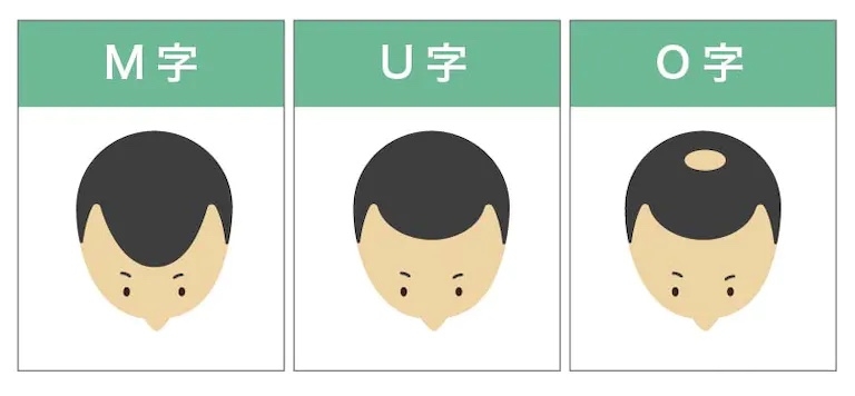 推しが禿げてきた