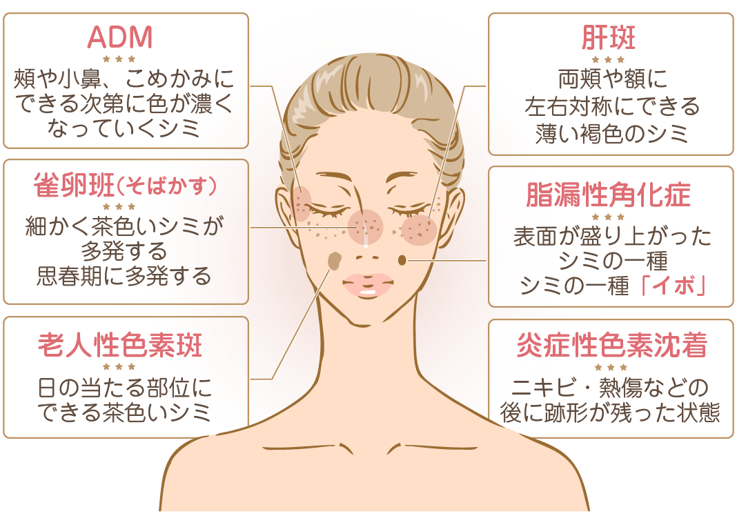【脱毛】vioの脱毛と色素沈着について【黒ずみ】