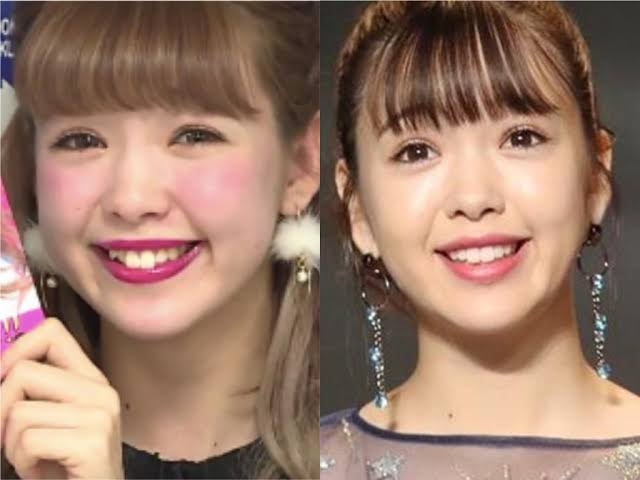 藤田ニコル　短い前歯の“仮歯の仮歯”姿披露に「自然！」「より大人っぽい」の声
