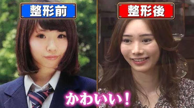 総額420万をかけてコンプレックスを解消　10回の施術から起業した女性「美容整形を努力だという文化を作りたい」