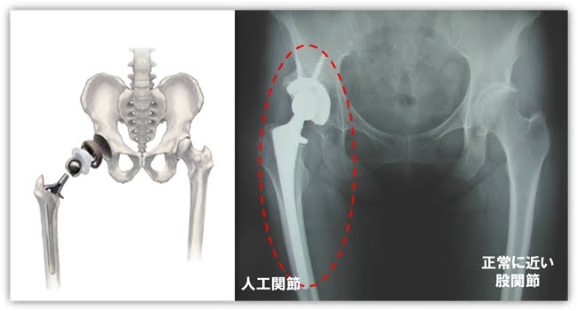 治療した歯や人工関節… 火葬場「遺灰」から金プラ 自治体が「換金」の是非